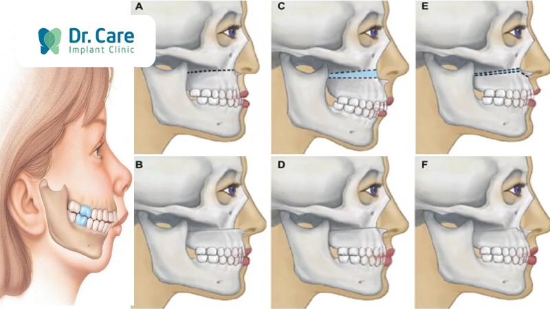 Phương pháp phẫu thuật răng hô vẩu