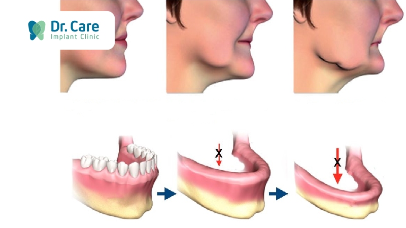 Mất răng bao lâu sẽ bị tình trạng tiêu xương hàm?