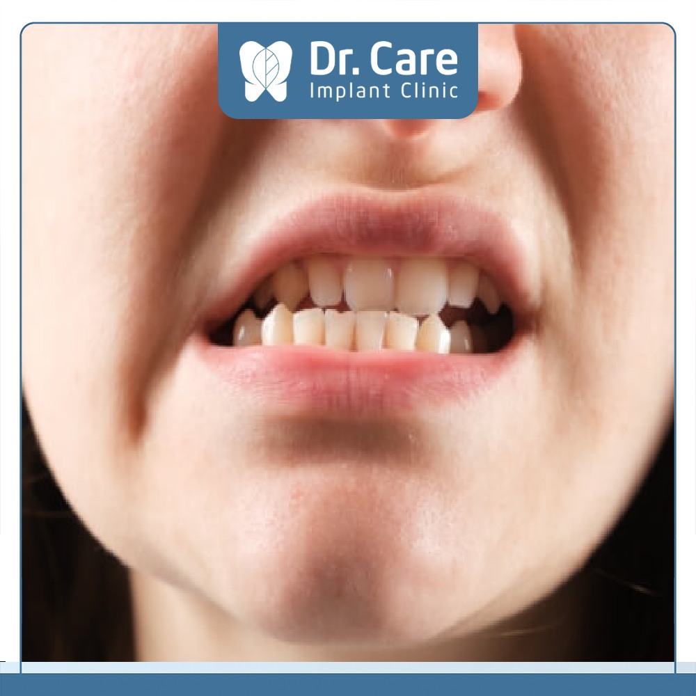 Răng khôn mọc lệch Ảnh hưởng cấu trúc hàm, lệch khớp cắn