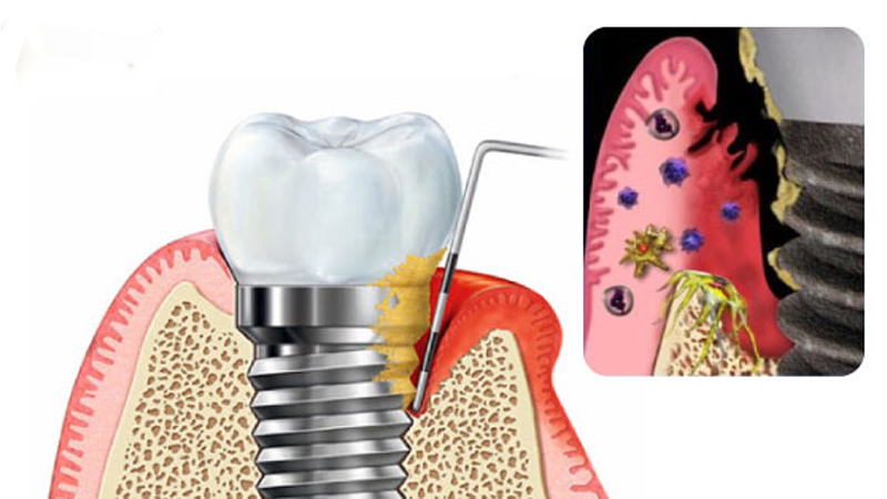 Trồng răng Implant giá rẻ khi sử dụng dòng trụ Implant không đạt chuẩn