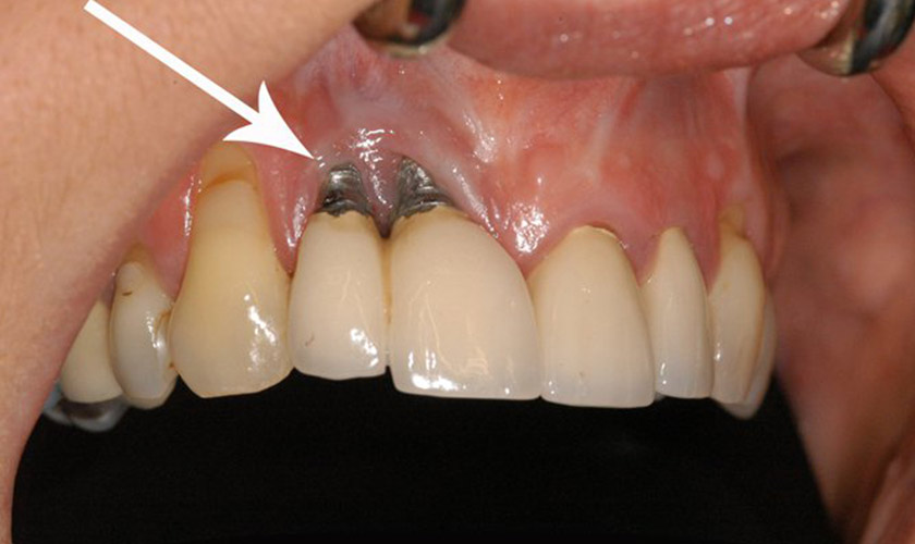 Trồng răng Implant giá rẻ, cẩn thận những hiểm họa khôn lường
