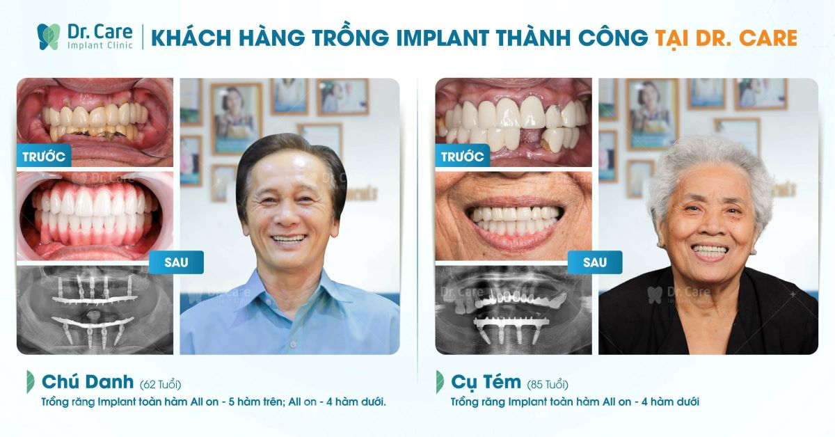 Trồng răng Implant có khắc phục tình trạng xô lệch răng do mất răng không?