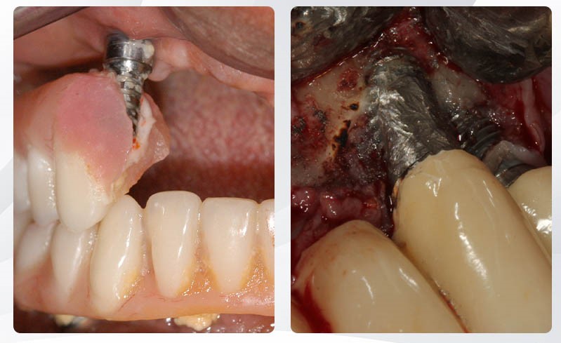 Trồng răng Implant giá rẻ có thực sự tiết kiệm chi phí không?