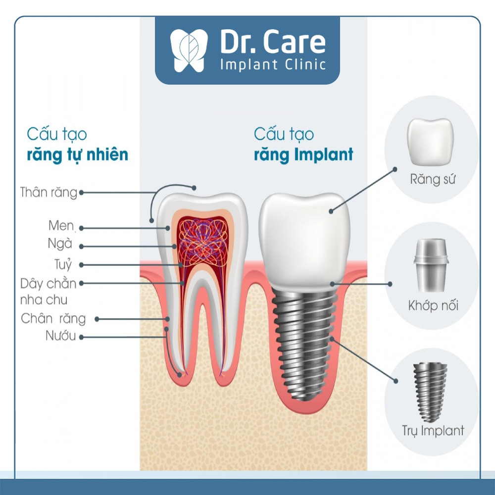 Cấu tạo của răng Implant 