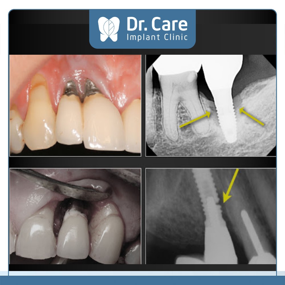 Nhược điểm của trồng răng Implant
