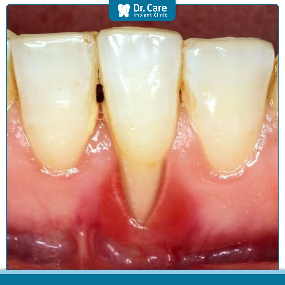 Các dấu hiệu nhận biết răng bọc sứ bị tụt lợi