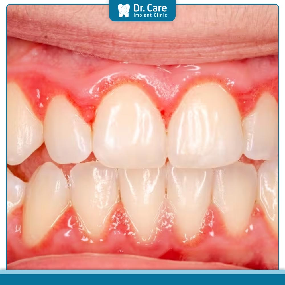 Các dấu hiệu nhận biết răng bọc sứ bị tụt lợi