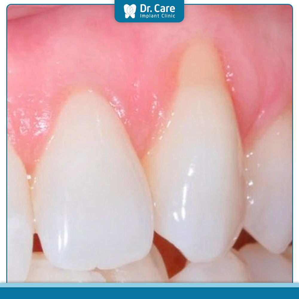 Tác hại của việc bọc răng sứ làm tụt lợi