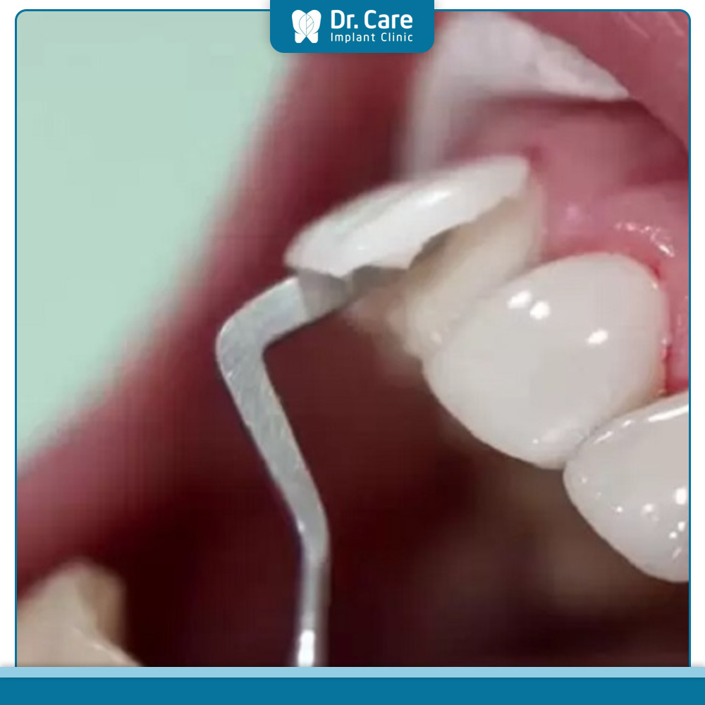 Làm sao để khắc phục tụt lợi khi bọc răng sứ?