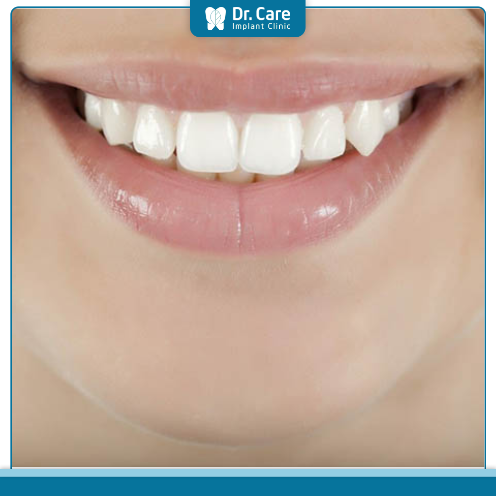 Bọc răng sứ răng khểnh có ảnh hưởng tới sức khỏe không?