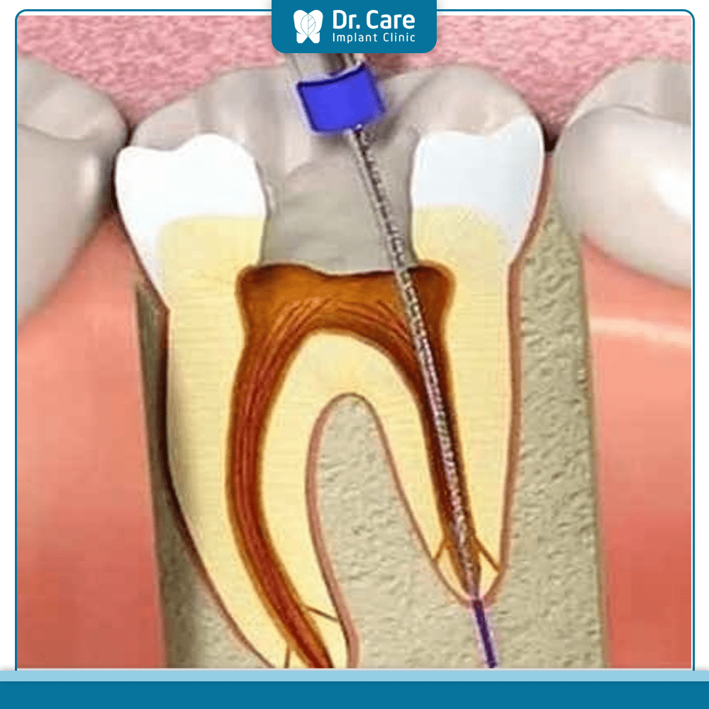 Nên bọc sứ răng hàm trong trường hợp nào?