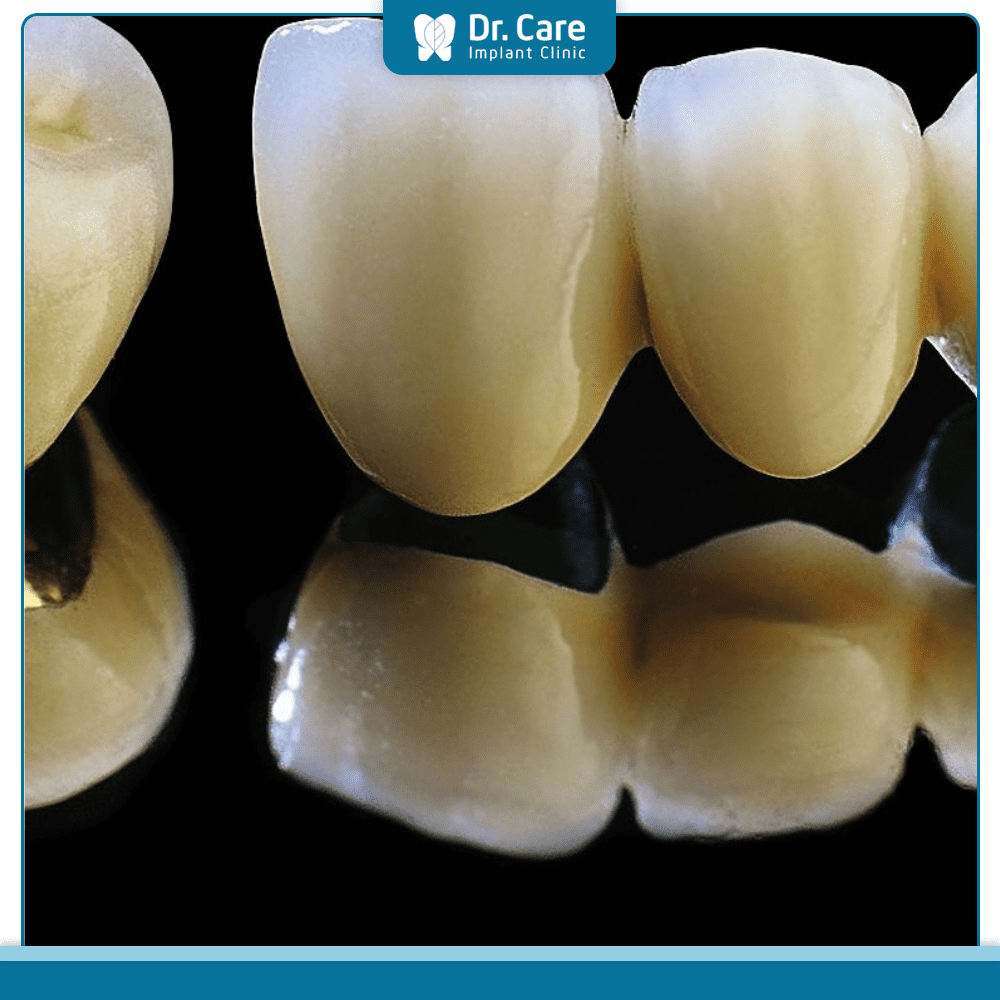 Răng hàm phù hợp với loại răng sứ nào?