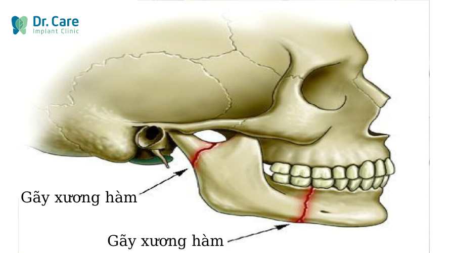 Tổn thương trực tiếp vùng xương hàm