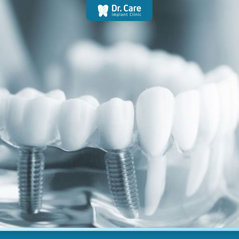 Phù hợp để với các trường hợp cần cấy ghép Implant
