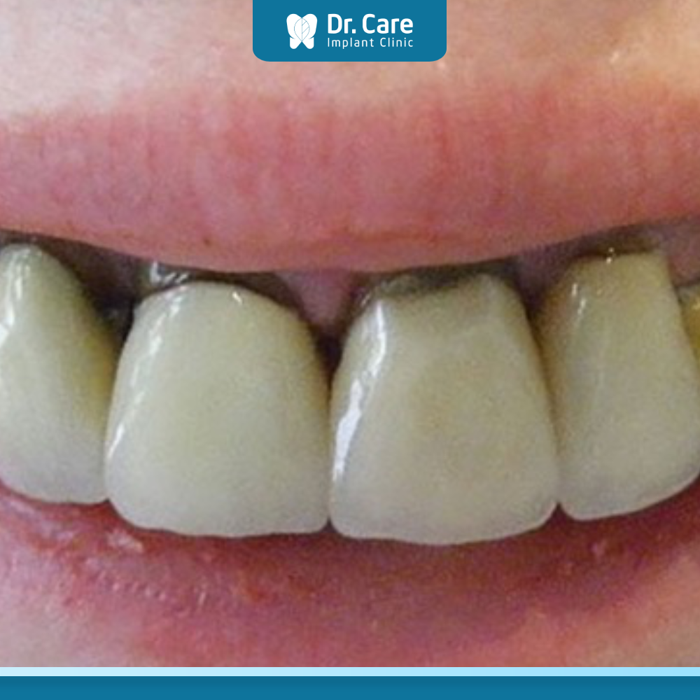 Răng sứ rất dễ bị đen ở phần viền nướu
