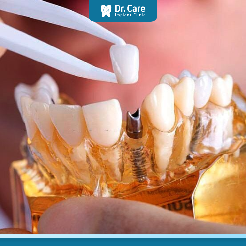 Răng sứ Titan khi phục hình có độ tương thích rất cao