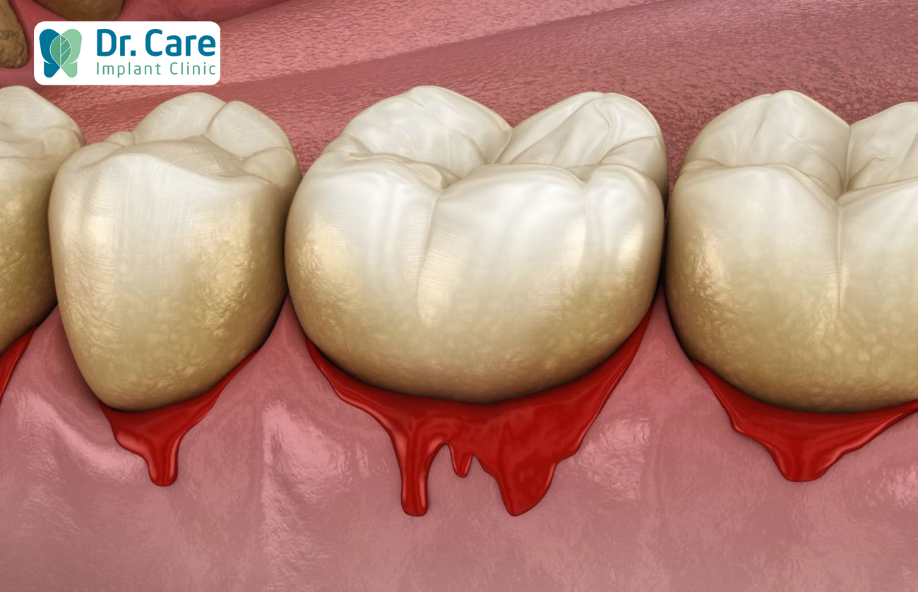 Khó nuốt hoặc đau nhiều hoặc chảy máu nướu răng