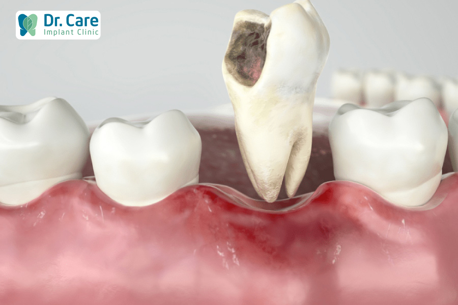 Điều trị đau răng với bệnh sâu răng