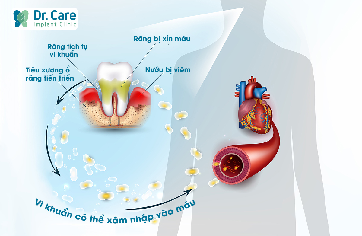 Bệnh tim và phổi có thể gây ra đau nhức răng