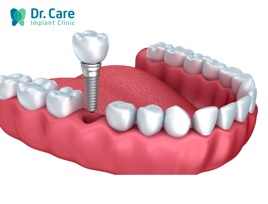 trồng lại răng số 6 bằng phương pháp Implant