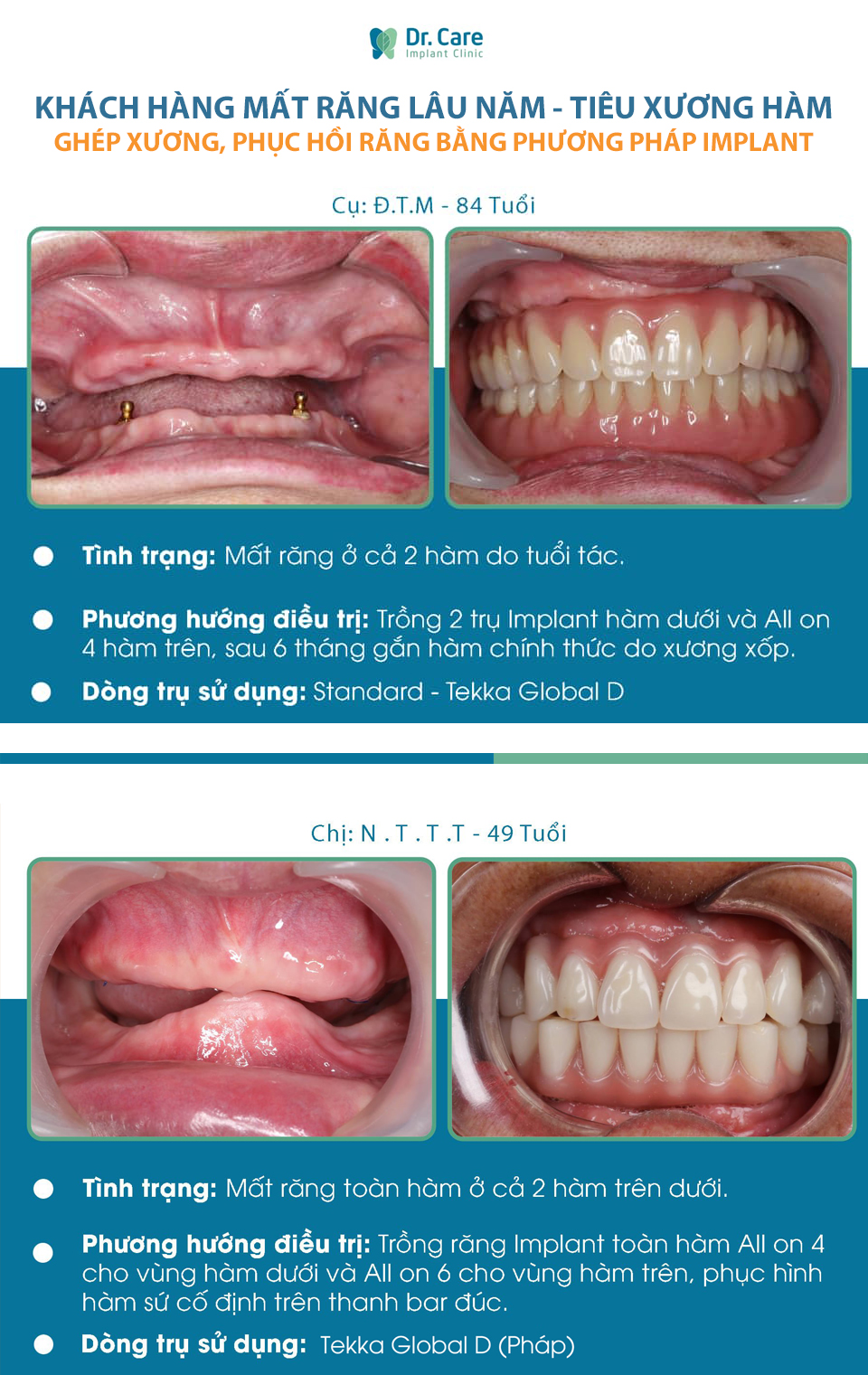 Dạng tiêu xương răng thường gặp khi mất răng