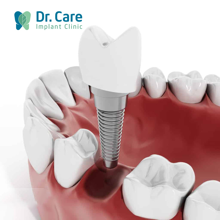 Trồng Implant răng hàm phục hồi hàm răng khỏe mạnh