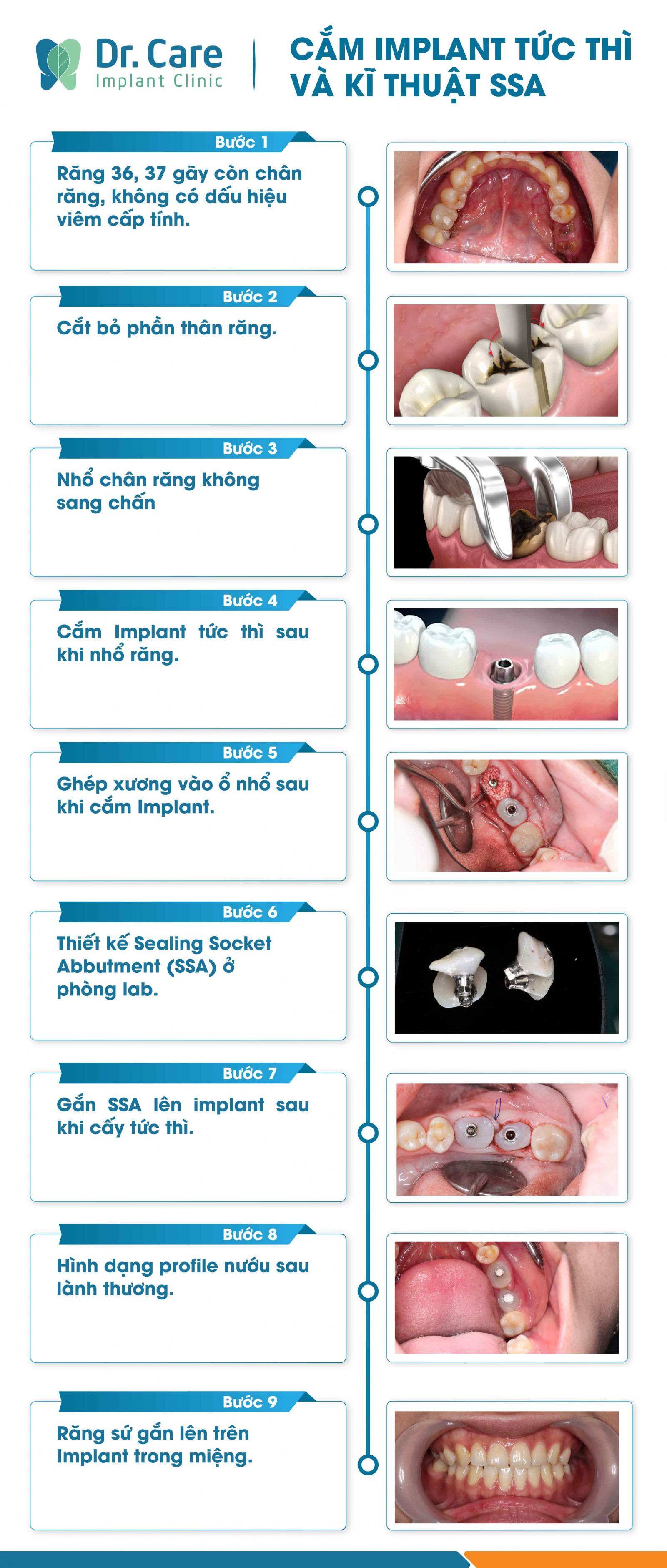 Các bước cơ bản thực hiện cấy ghép Implant và ứng dụng kỹ thuật nắp lành thương ổ răng sau khi cấy ghép.