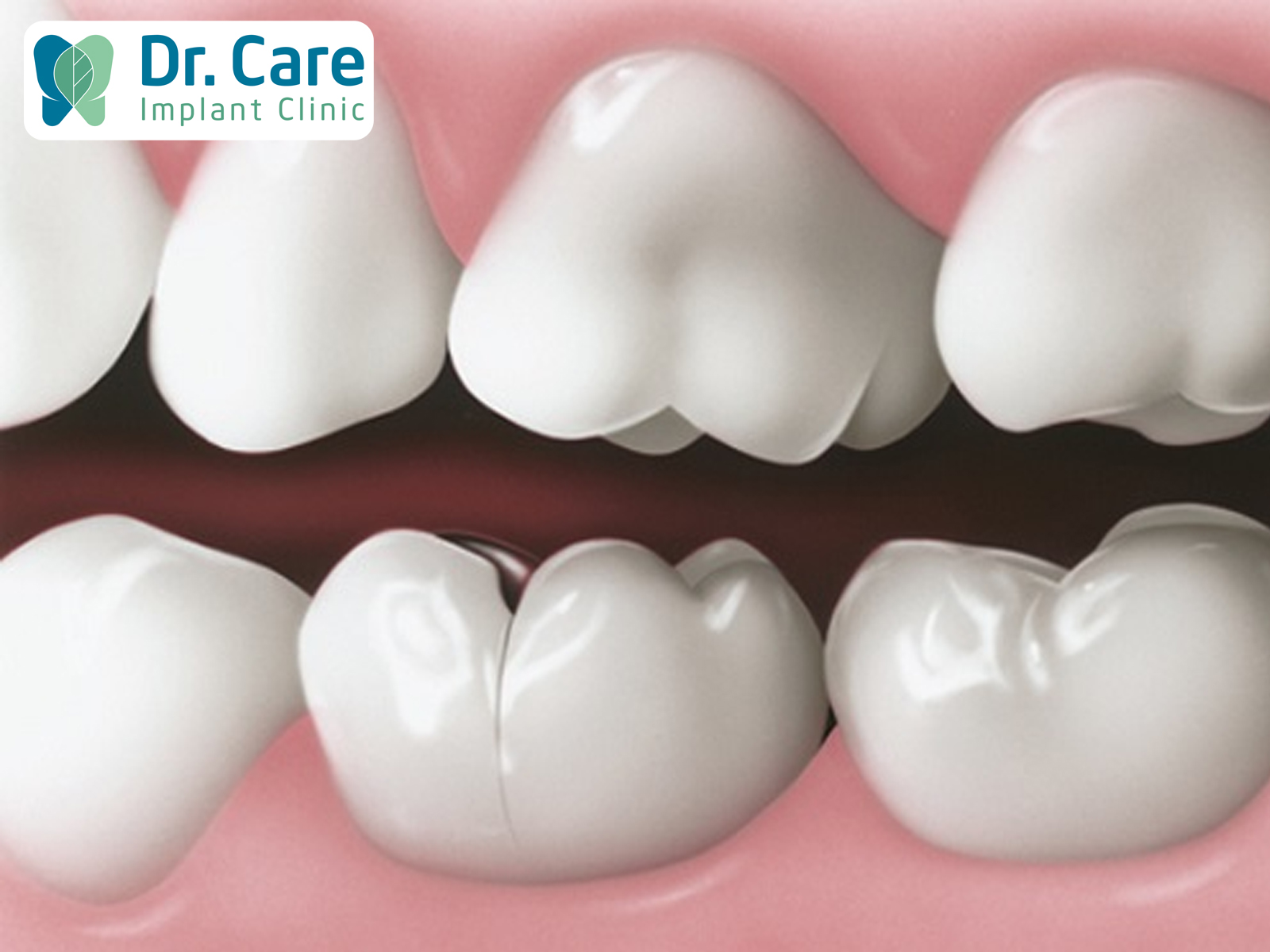 Sau khi răng được mài để bọc sứ, tình trạng bề mặt răng bị rạn nứt là một tình trạng cần thảo luận ngay với Bác sĩ điều trị