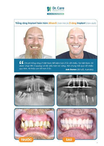 Trồng răng Implant khôi phục răng bị mất do sâu răng nặng