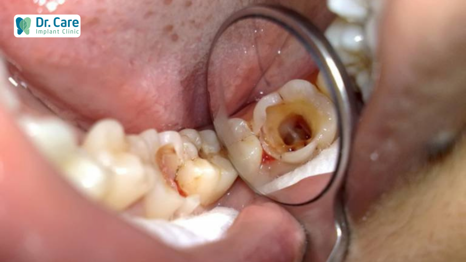 Dấu hiệu hư tủy răng cần điều trị tủy