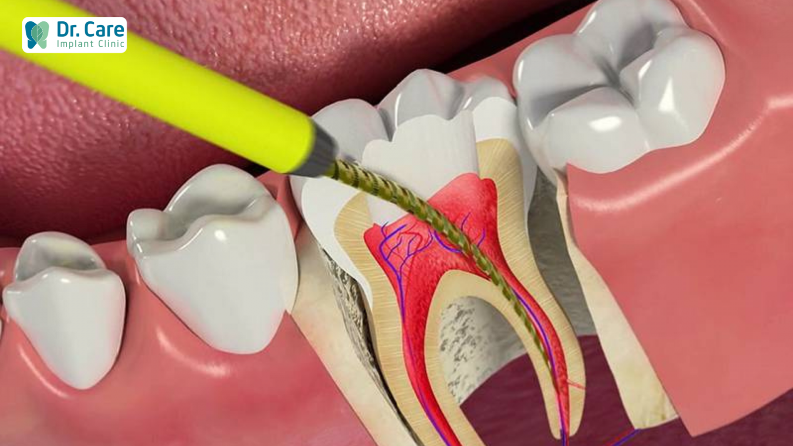 Phương pháp điều trị răng chết tủy hiệu quả