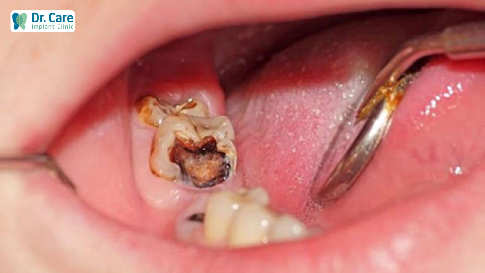 Dấu hiệu nhận biết răng chết tủy