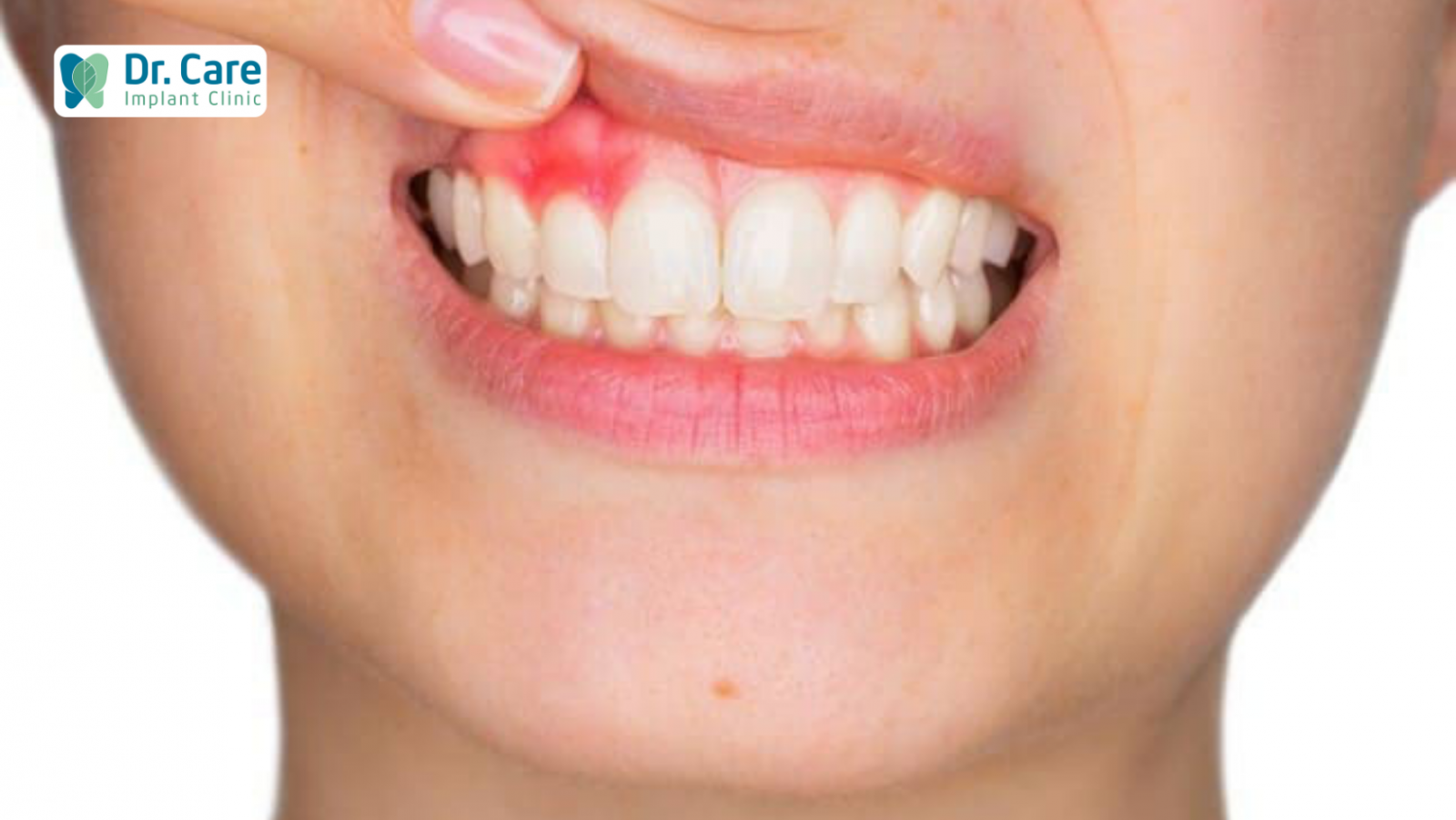 Răng chết tủy có nguy hiểm không?