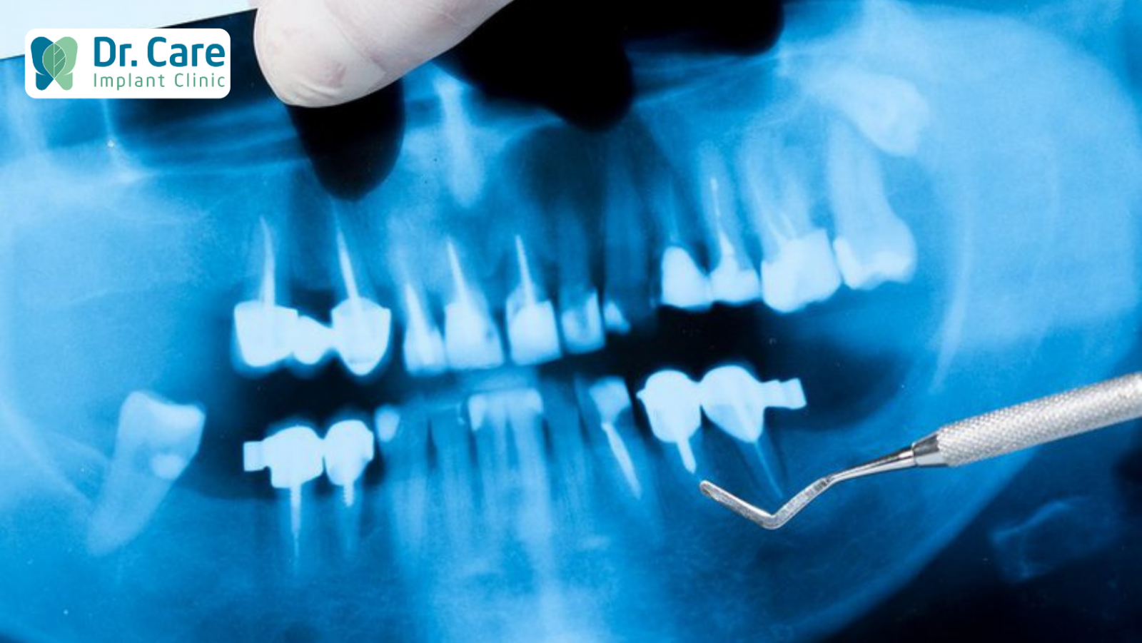 Phương pháp điều trị răng chết tủy hiệu quả