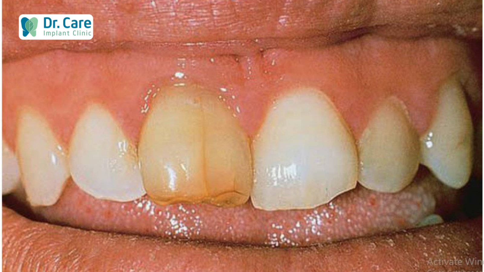 Răng chết tủy là gì?