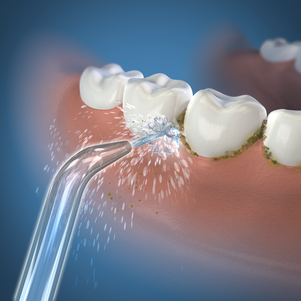 Mảng bám răng tích tụ từ nhiều loại vi khuẩn có trong răng miệng