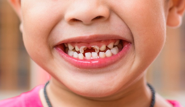 Sâu răng là hậu quả thường thấy do mảng bám gây ra