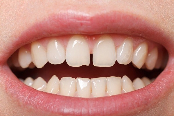 Bạn có thể che giấu những khuyết điểm của răng bằng cách bọc răng sứ