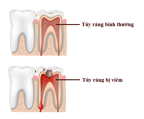 Viêm tủy răng do bọc răng sứ có thể làm hư toàn bộ răng