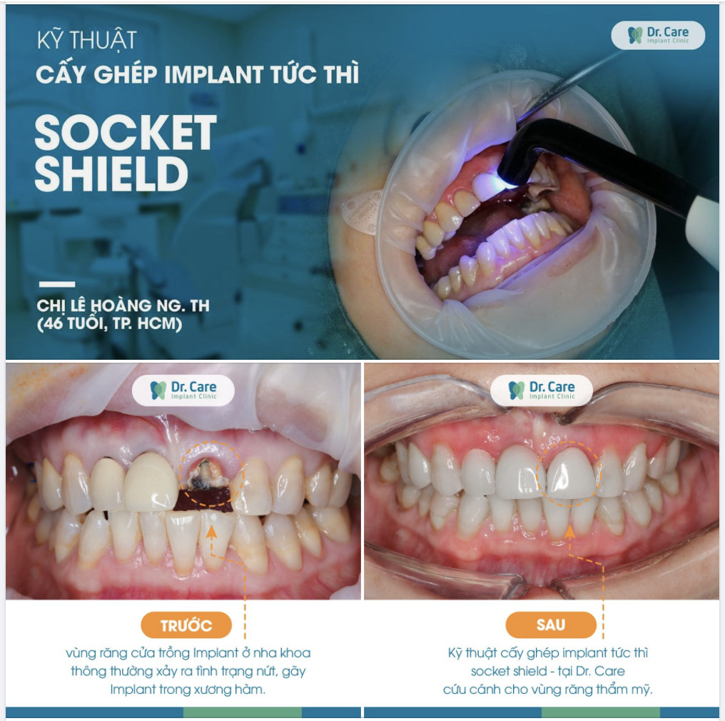 Sau khi trồng răng Implant bằng kỹ thuật Socket Shield phần răng cửa của chị Ng. Th. hài hòa, tự nhiên gần như răng thật