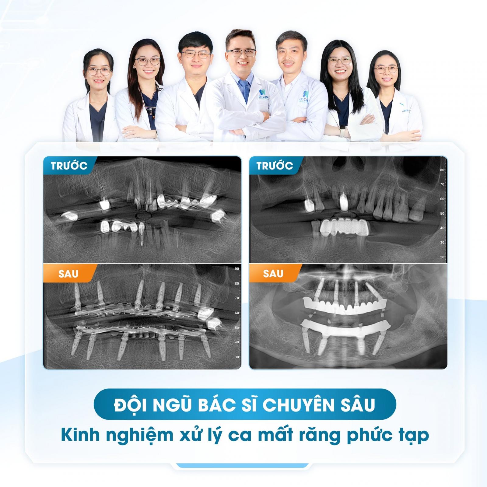 Đội ngũ bác sĩ chuyên sâu Implant, kinh nghiệp xử lý ca mất răng phức tạp