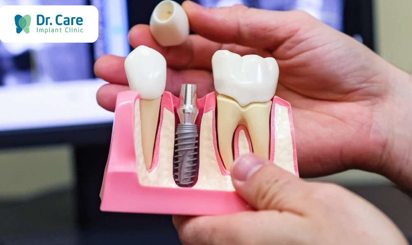 Nhược điểm của trồng răng Implant trên quan điểm y khoa