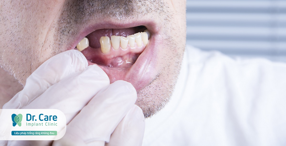 Biến chứng nguy hiểm do mất răng hàm