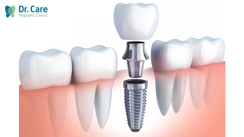 Trồng răng Implant phục hồi răng hàm đã mất tại Dr. Care 