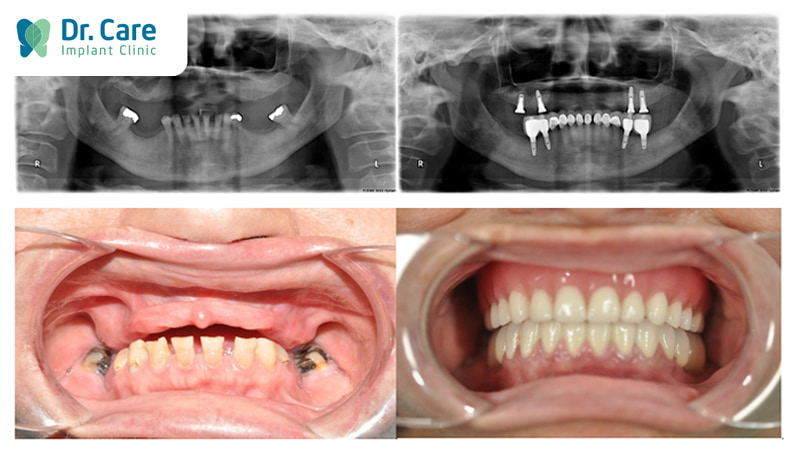 Vì sao nên trồng răng Implant ngay khi mất răng số 2?