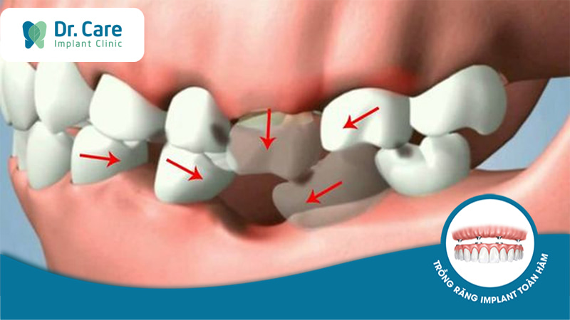 Mất răng là gì?