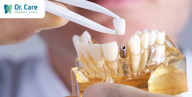 Mất răng tiến hành trồng răng Implant cần lưu ý những gì?