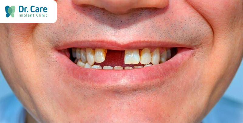 Nguyên nhân mất răng thường gặp