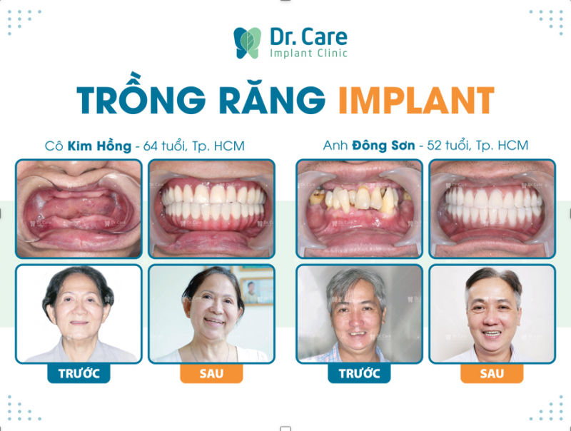 Phương pháp trồng răng Implant khắc phục nhược điểm của hàm tháo lắp toàn hàm