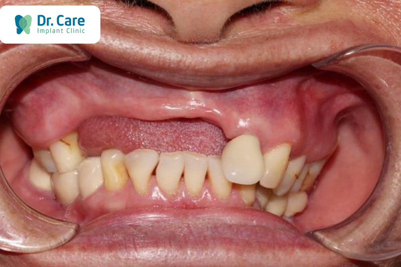 Tiêu chí chọn phương pháp phục hình mất 4 răng liên tiếp